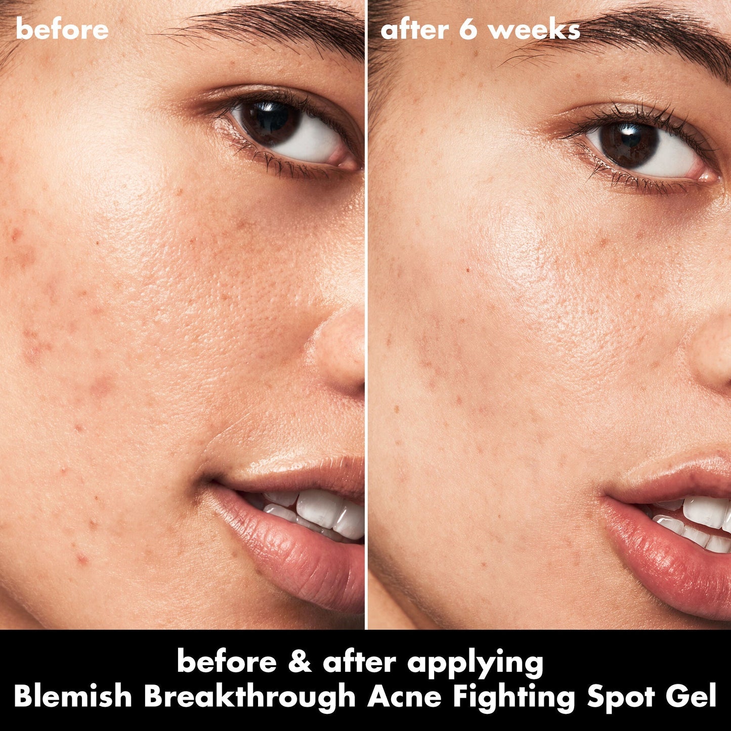 blemish-breakthrough-acne-fighting-spot-gel-n6 0326_EDU_BB_SpotGel_BA_ISABELLA.jpg