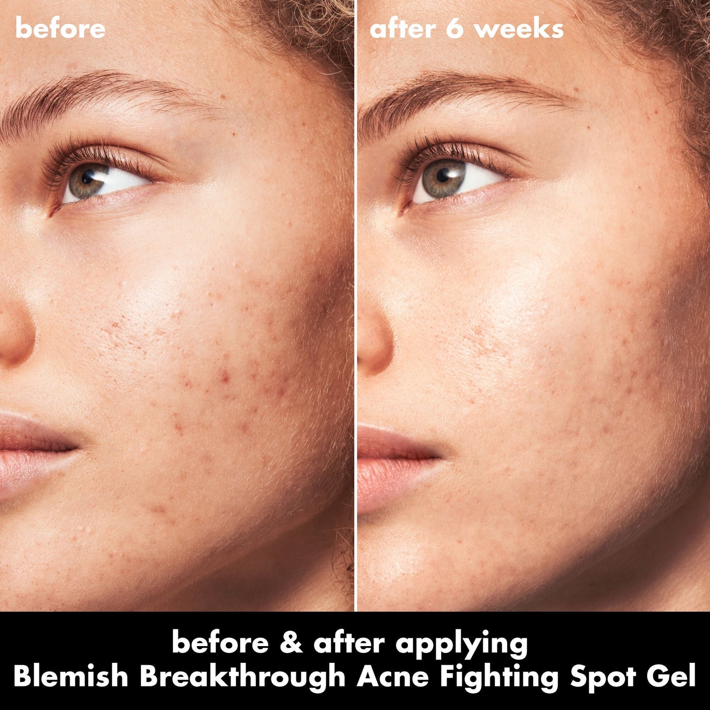 blemish-breakthrough-acne-fighting-spot-gel-n6 0326_EDU_BB_SpotGel_BA_MARLEY.jpg