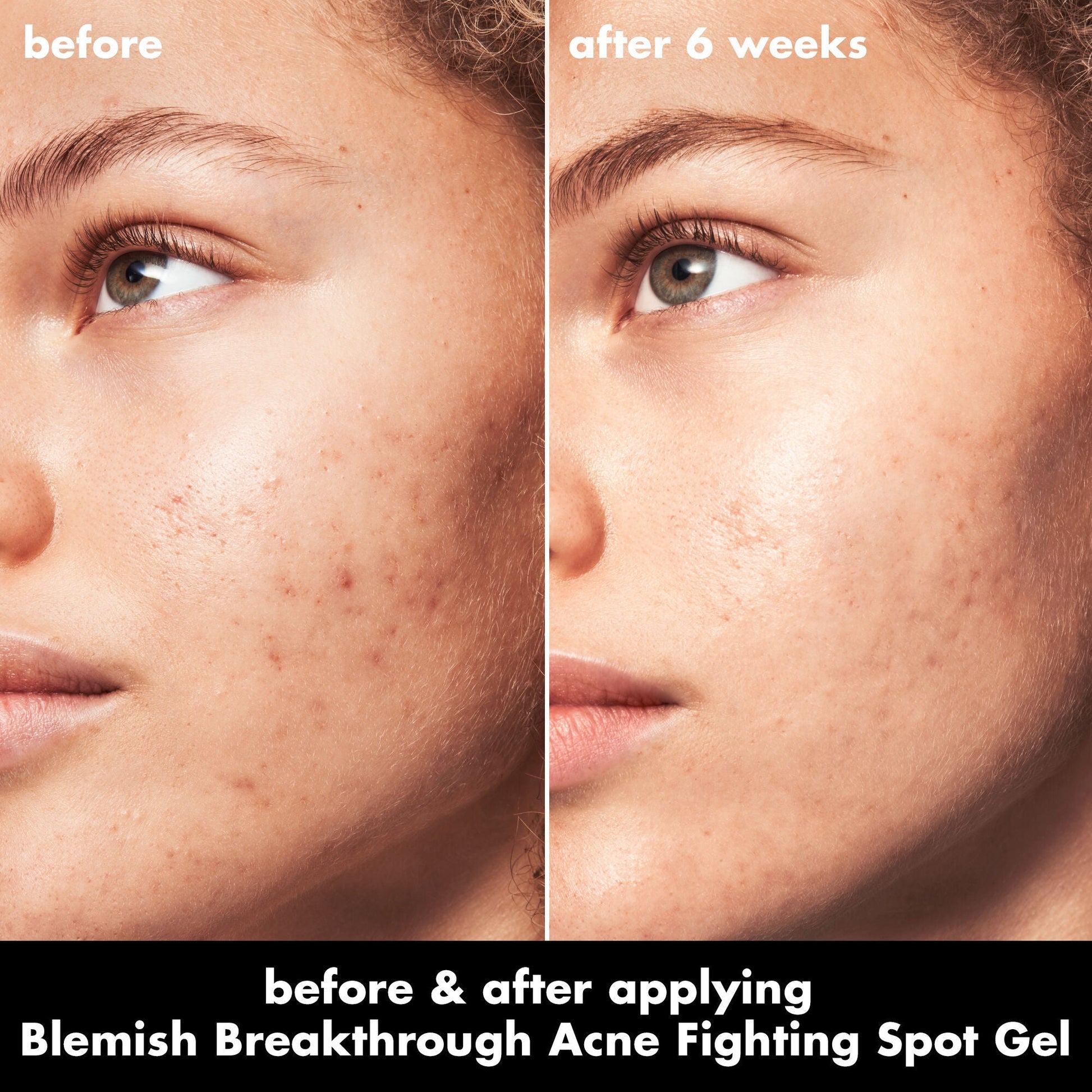 blemish-breakthrough-acne-fighting-spot-gel-n6 0326_EDU_BB_SpotGel_BA_MARLEY.jpg