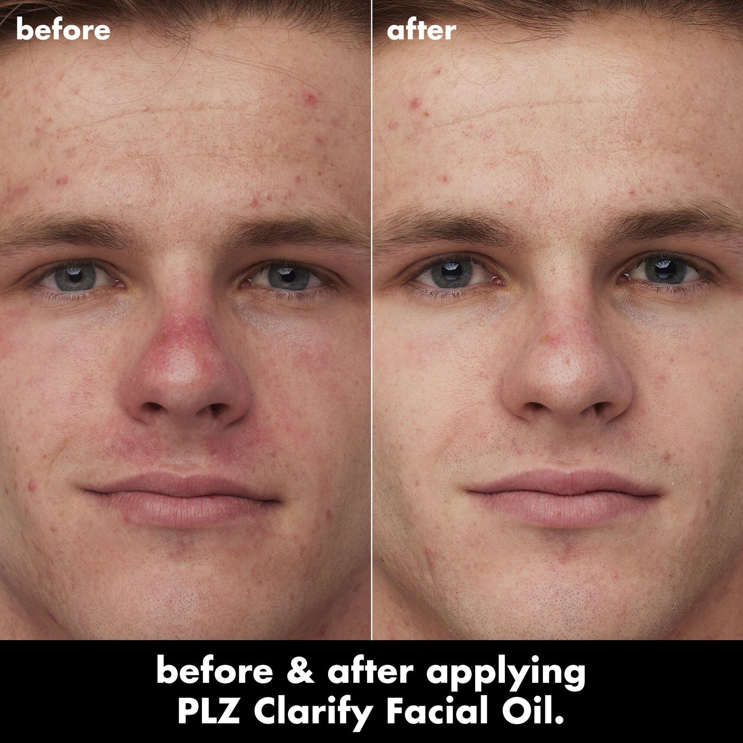 plz-clarify-facial-oil-e0 0326_EDU_PlzClarify_BA_Caleb.jpg
