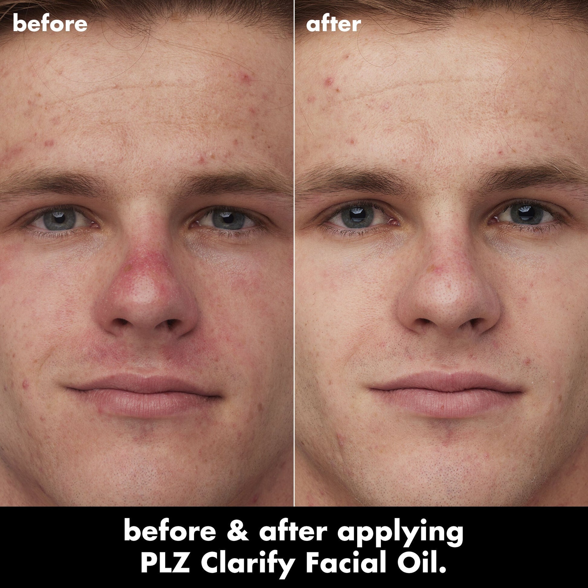 plz-clarify-facial-oil-e0 0326_EDU_PlzClarify_BA_Caleb.jpg