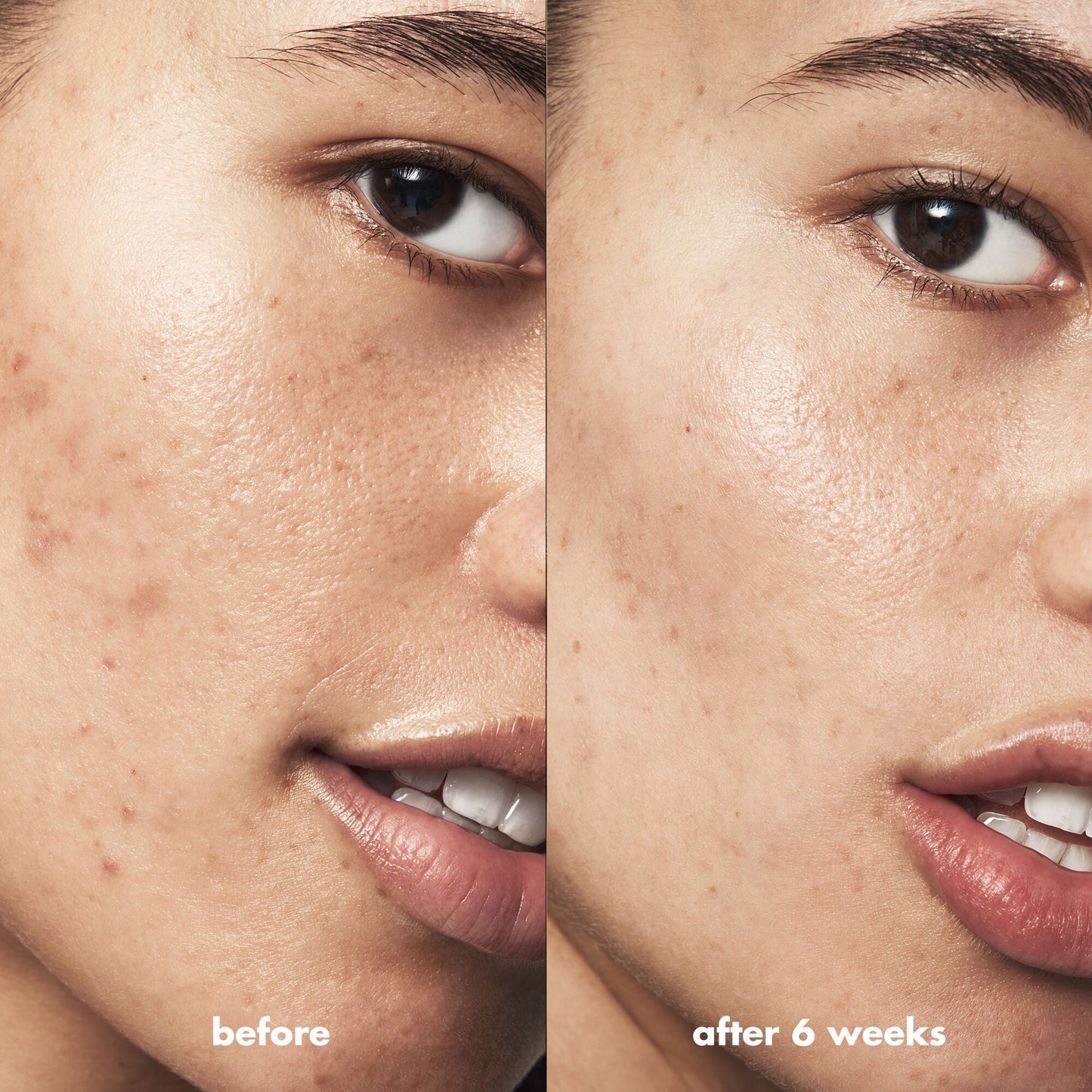 blemish-breakthrough-acne-calming-water-cream-mini-k9 Acne_PDP_Isabella_Before_After_f0d452cd-72f5-4bb8-a6df-0b3cc23143ef.jpg