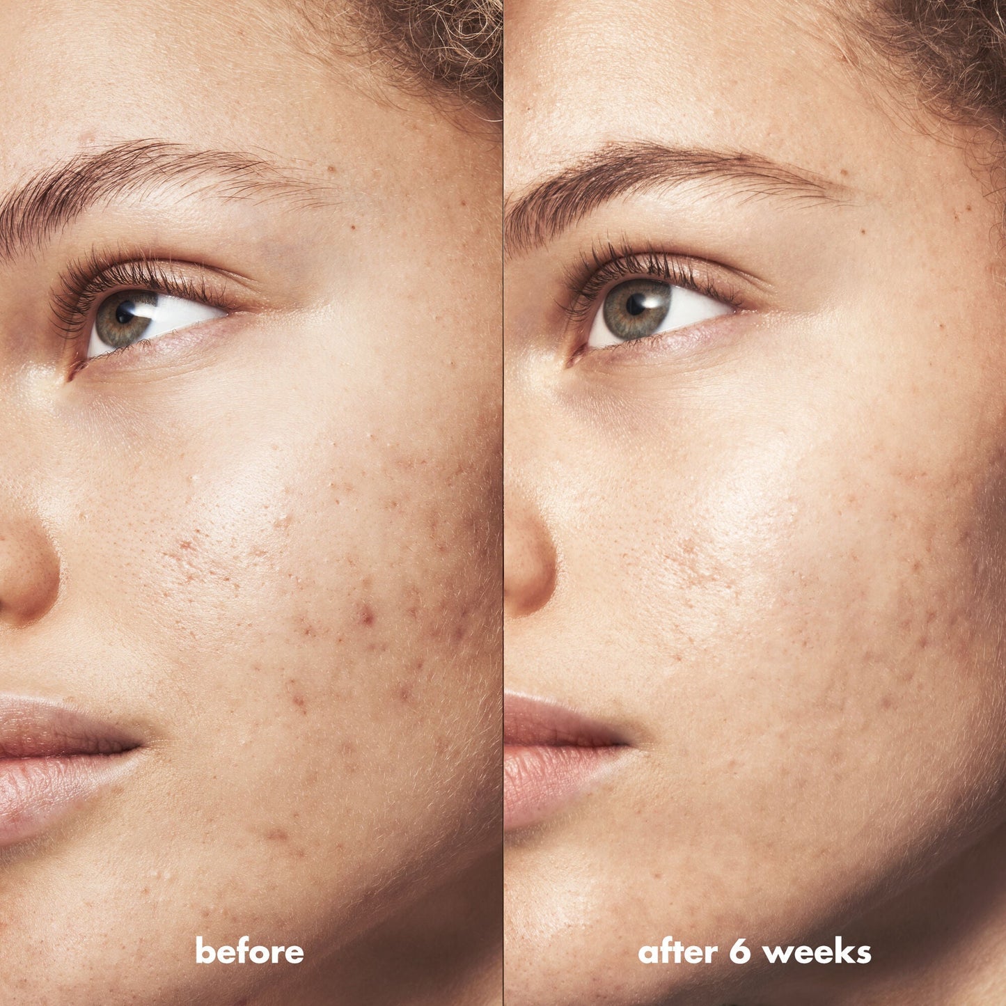 blemish-breakthrough-blemish-control-basics-kit-a4 Acne_PDP_Marley_Before_After_295728d2-6728-4f48-b8ef-c82bbca5b591.jpg
